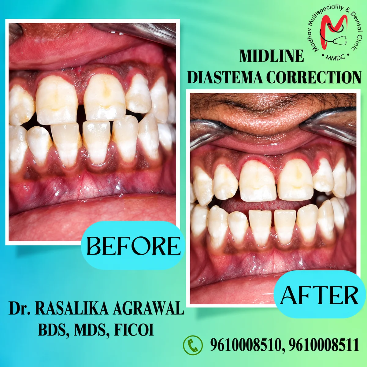 Midline diastema correction before-after
